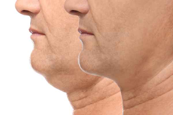 HIFU - Breakthrough in Anti - ageing 2 hifu results Birmingham