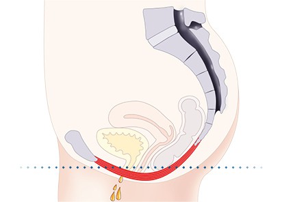 Pelvic-Floor Muscle Repair 5 Pelvic floor muscles Birmingham