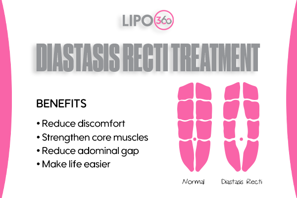 Revolutionising Muscle Repair: The Power of LIPO360 Body Sculpt Post-Injury 5 diastasis recti treatment Birmingham
