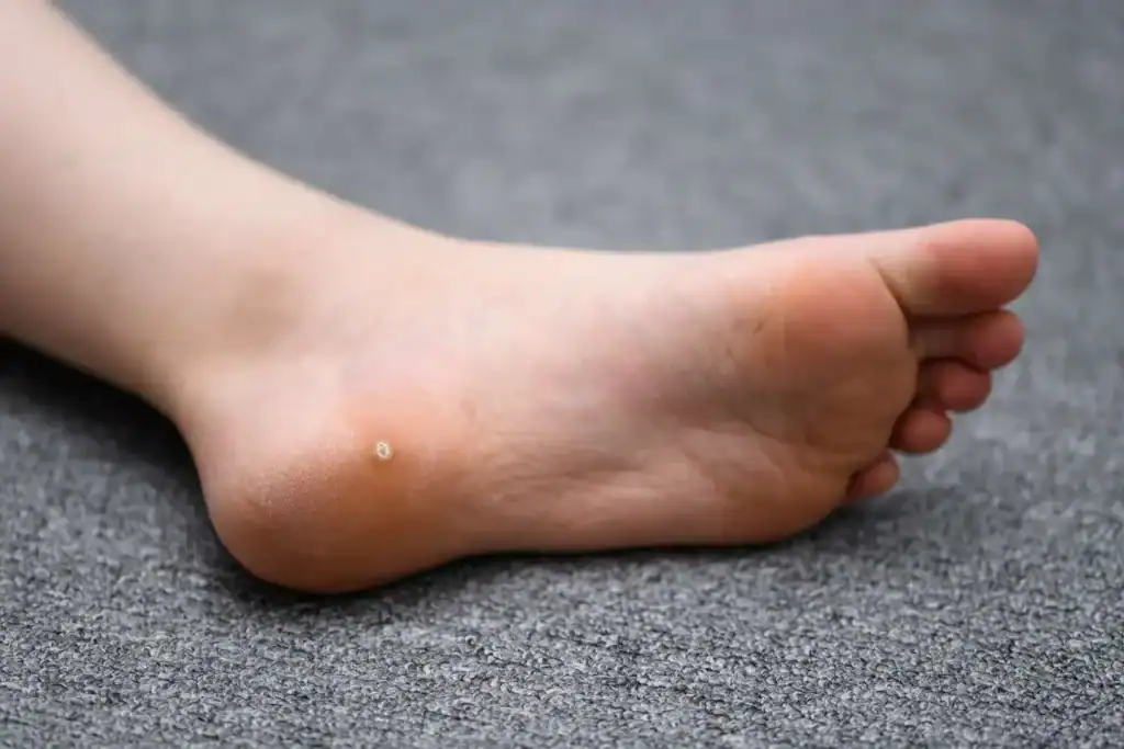 Cryotherapy For Warts And Also Verrucas 2 Image of verruca on the bottom of the foot that able to be treated with Cryotherapy Birmingham