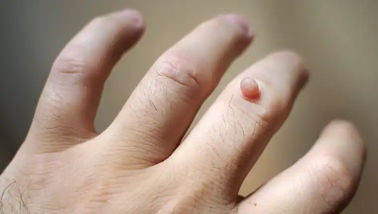 Image of blemish that Cryotherapy Birmingham can remove with Lipo 360.
