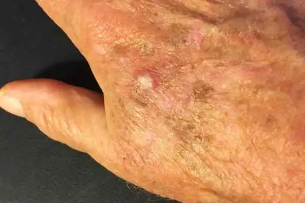 Image of Actinic keratoses Birmingham on a person hand
