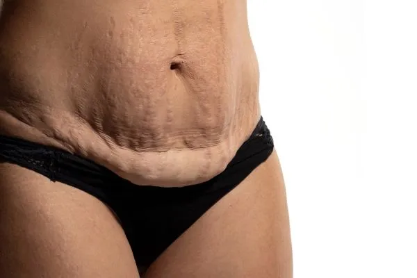 The science behind skin tightening Birmingham picture of a woman's sagging skin on the stomach